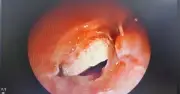 Hạt Hạnh Nhân Ẩn Trong Phổi Bé Gái 7 Ngày: Bác Sĩ Sáng Tạo Dùng Dụng Cụ Tim Mạch Cứu Sống