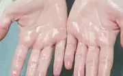 Khắc Phục Mồ Hôi Tay: 9 Phương Pháp Đơn Giản Từ Thiên Nhiên Đến Hiện Đại
