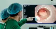 Nam bệnh nhân 47 tuổi phát hiện đồng thời hai ung thư nguy hiểm do thói quen uống rượu