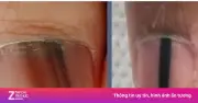Sọc Sẫm Màu Trên Móng Tay, Móng Chân: Dấu Hiệu Bệnh Lý Cần Cảnh Giác