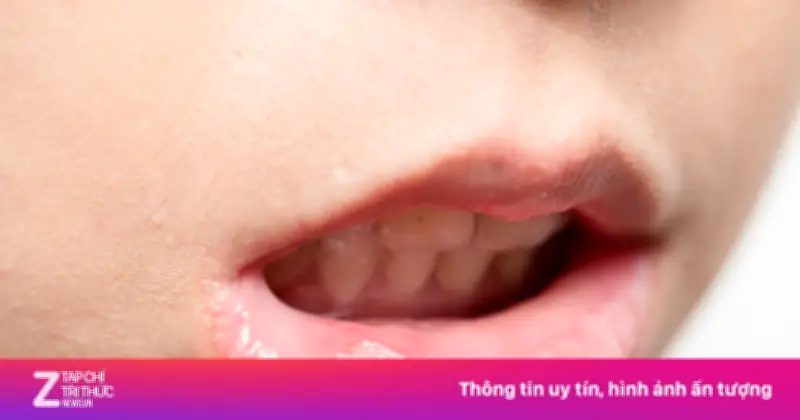 5 món ăn quen thuộc âm thầm 'kích hoạt' ung thư miệng, nhiều người chủ quan