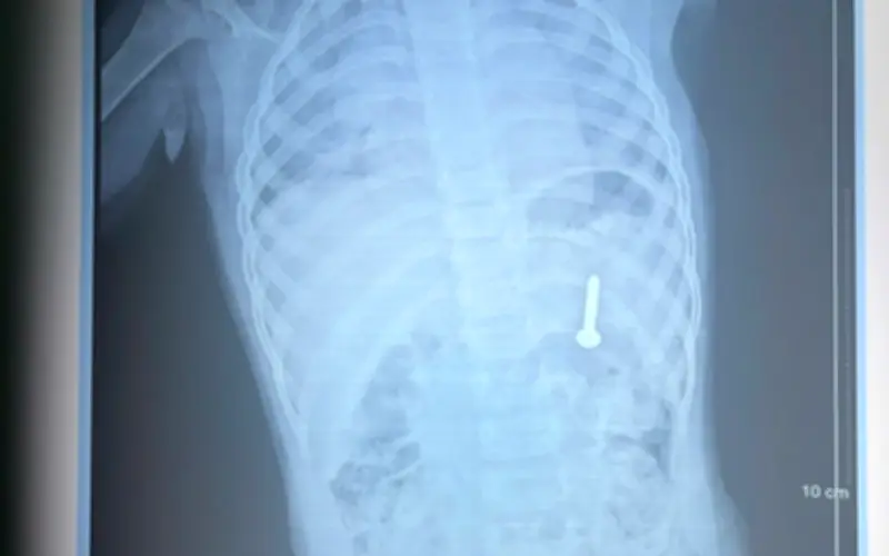 Bé 21 tháng tuổi nuốt đinh vít, bác sĩ Quảng Trị nội soi cấp cứu thành công