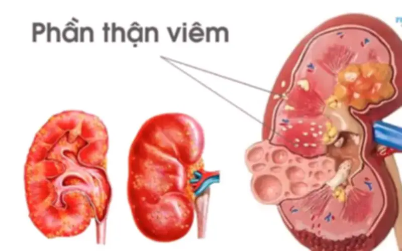 Bé gái 11 tuổi co giật, tăng huyết áp sau viêm họng do biến chứng viêm cầu thận