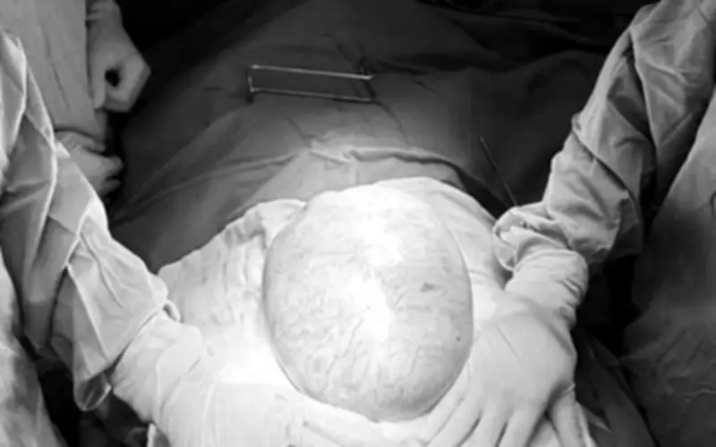 Bé gái 13 tuổi mang khối u buồng trứng nặng 4kg được phẫu thuật thành công tại TP.HCM