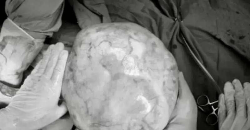 Bé gái 14 tuổi mang khối u khủng, dấu hiệu dễ nhầm với tăng cân tuổi dậy thì