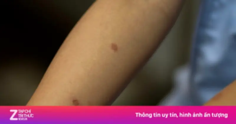 Bé gái 14 tuổi mắc nấm da nặng sau khi chơi với mèo, cảnh báo sai lầm khi tự ý dùng thuốc
