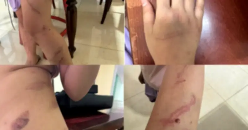 Bé gái 9 tuổi bị nghi bạo hành với 34 vết bầm tím, công an vào cuộc điều tra
