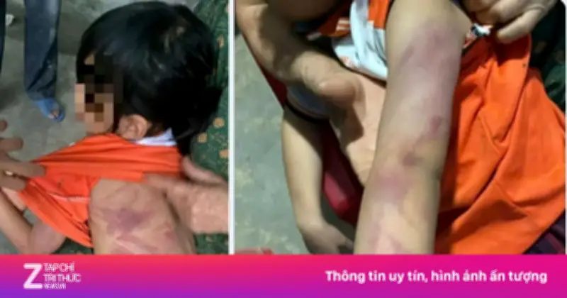 Bé gái lớp 2 ở Hà Tĩnh bị bạn dùng thước đánh bầm tím người trong giờ ra chơi