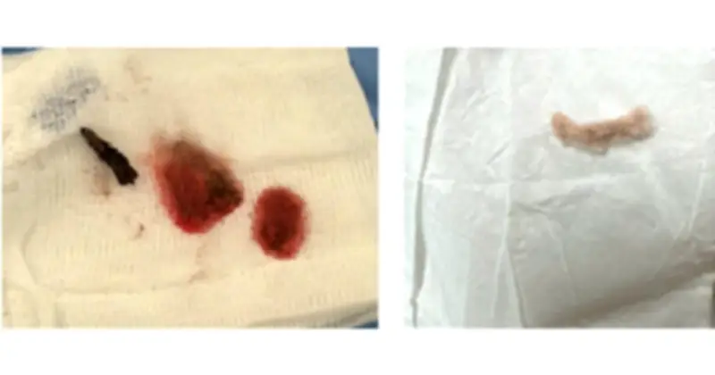 Bé trai 3 tuổi ở Đồng Tháp thoát chết nhờ phẫu thuật lấy dị vật kẽm nhung trong phổi