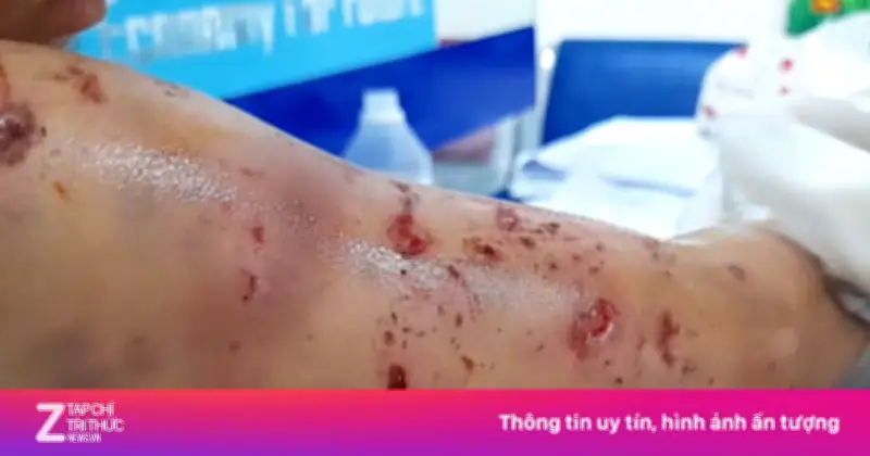 Bé trai 4 tuổi ở Tuyên Quang bị chó nhà tấn công, toàn thân chi chít vết cắn