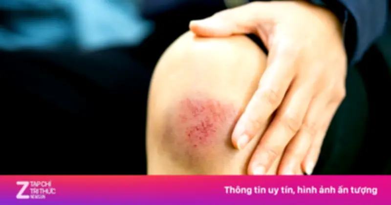Bị trầy xước da nên ăn gì để vết thương mau lành và hạn chế sẹo?