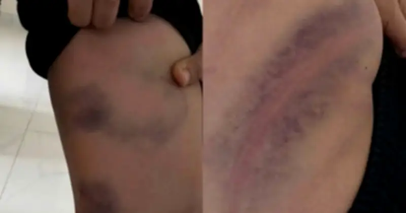 Bắc Ninh: Bé trai 11 tuổi bị bố đánh bằng dây điện, công an vào cuộc điều tra