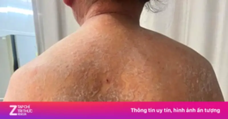 Bác sĩ sốc khi bệnh nhân phủ kín nấm toàn thân do tự ý bôi thuốc sai cách