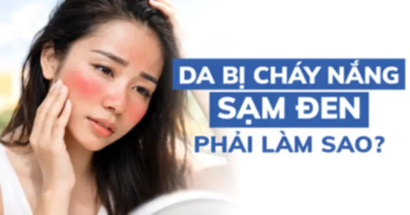 Bỏng Nắng Không Chỉ Là Đỏ Da: Cảnh Báo Nguy Cơ Và Bí Quyết Phục Hồi Thần Tốc