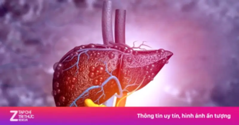Bệnh gan nhiễm mỡ MASLD: 'Kẻ giết người thầm lặng' không do rượu đe dọa hàng tỷ người