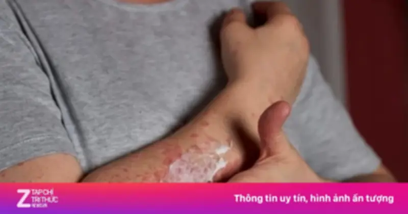 Bệnh Ghẻ: Hiểu Sai Nguyên Nhân, Cả Gia Đình Có Thể Cùng Mắc