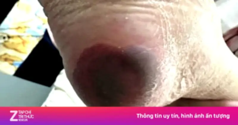 Bệnh nhân 61 tuổi thoát chết sau khi bị mảnh sành đâm gây uốn ván nặng