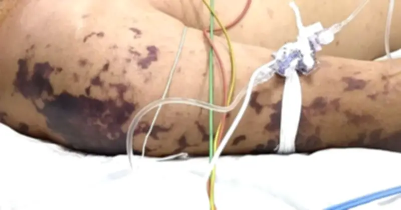 Bệnh não mô cầu gia tăng: 24 ca mắc, 4 tử vong từ đầu năm 2026