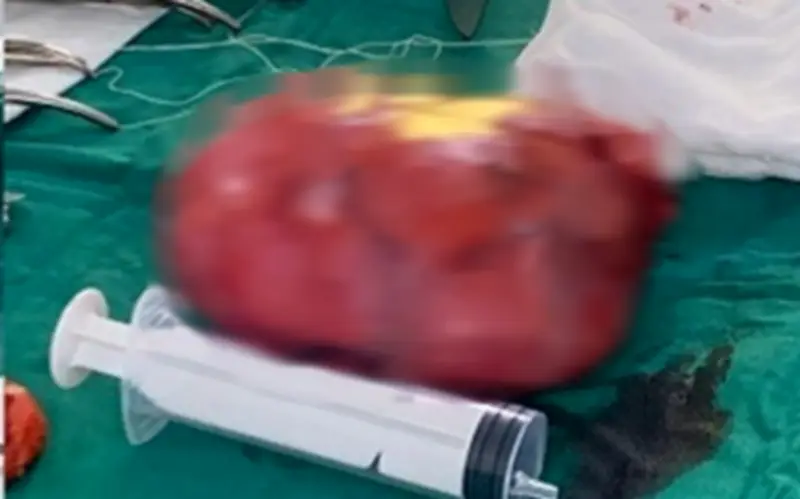 Bệnh viện Bắc Ninh phẫu thuật thành công khối u sau phúc mạc nặng gần 1 kg ở bệnh nhân cao tuổi