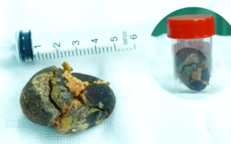 Bệnh viện Gia An 115 lấy sỏi mật to như quả trứng gà cho bệnh nhân nữ