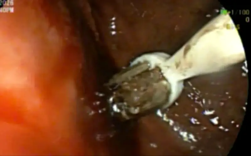 Bệnh viện Trung ương Huế can thiệp thành công cứu bệnh nhân nuốt 3 bàn chải đánh răng