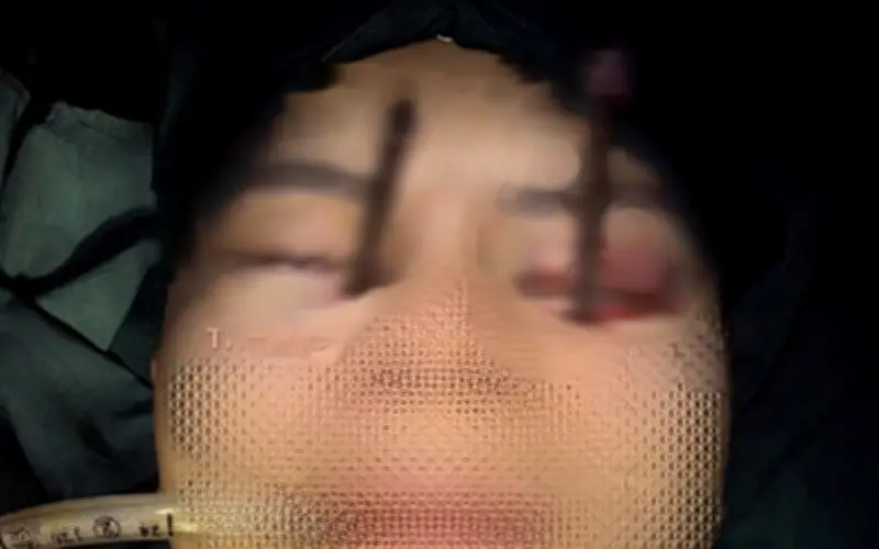 Bệnh viện Việt Đức cứu sống bệnh nhân bị đũa đâm sâu vào hai hốc mắt sau ca mổ căng thẳng