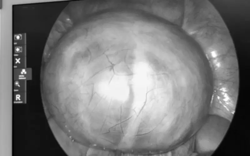 Bệnh viện Việt - Hàn Đà Nẵng phẫu thuật thành công khối u nang buồng trứng lớn 14cm