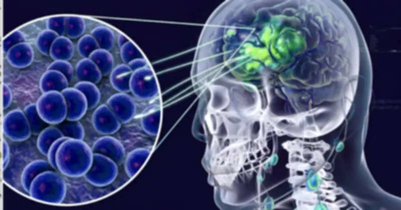 Cà Mau: 2 ca dương tính viêm não mô cầu, 1 tử vong, ngành y tế khẩn trương kiểm soát