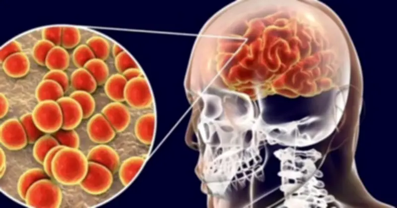 Cà Mau: 3 ca nghi viêm não mô cầu, 1 tử vong, ngành y tế khẩn trường ứng phó