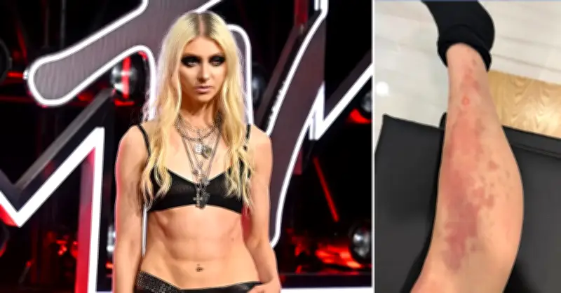Ca sĩ Taylor Momsen nhập viện cấp cứu sau khi bị nhện độc cắn tại buổi diễn