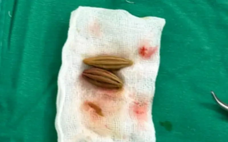 Cao Bằng: Cấp cứu thành công bệnh nhân cao tuổi bị thủng trực tràng do nuốt hạt nhót