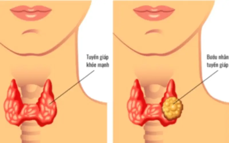 Chủ quan với nhăn tuyến giáp, người phụ nữ trẻ đi khám phát hiện 13 hạch di căn