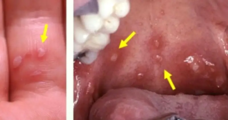 Chủng EV71 Biến Thể C1 Nguy Hiểm: Nguy Cơ Tái Nhiễm Và Dấu Hiệu Cảnh Báo