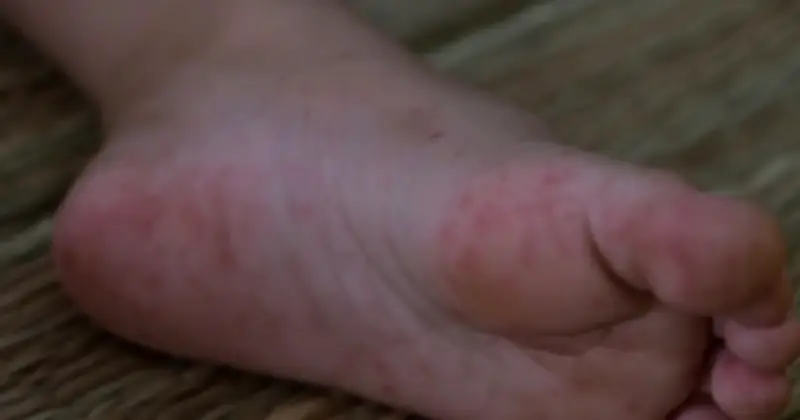 Cần Thơ báo động: Tay chân miệng và sốt xuất huyết tăng đột biến đầu năm 2026