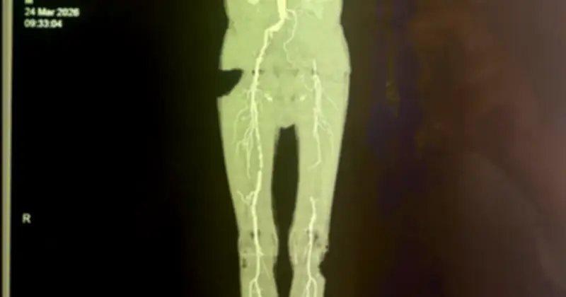 Cần Thơ: Can thiệp thành công, cứu chân trái cho bệnh nhân nguy cơ hoại tử