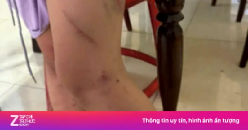 Công an Đắk Lắk xác minh vụ bé gái 9 tuổi có 34 vết bầm nghi bị mẹ bạo hành