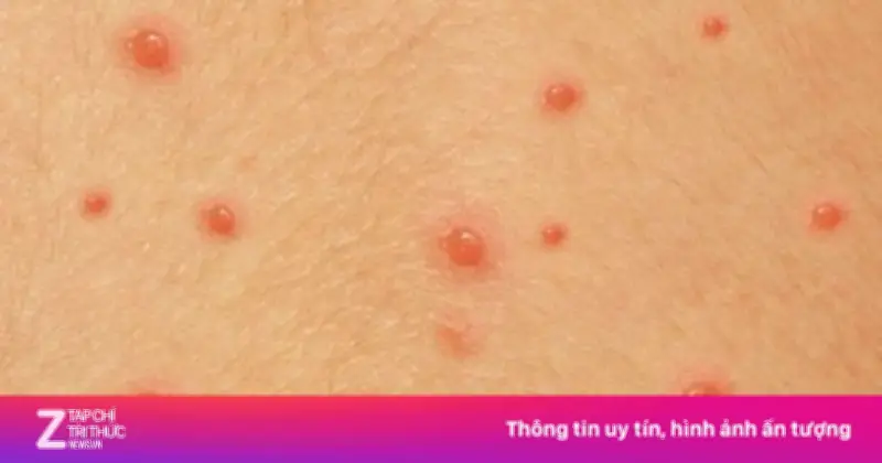 Cảnh báo: 'Bẫy' lây nhiễm thủy đậu khiến nhiều người chủ quan, tiềm ẩn nguy cơ lâu dài
