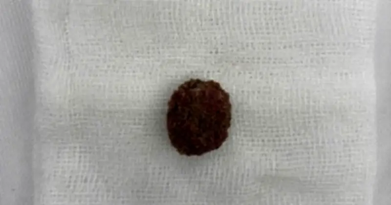 Cảnh báo từ bác sĩ: Tin quảng cáo thuốc tan sỏi trên mạng, bệnh nhân suýt mất thận