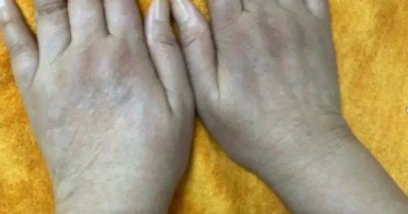 Cảnh báo từ bệnh nhân 68 tuổi: Dấu hiệu lạnh tay vô hại hóa ra là bệnh hiếm nguy hiểm