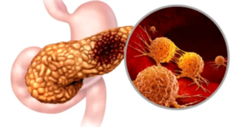 Cảnh báo từ Sơn Đông: Gia đình 3 người mắc ung thư tuyến pankreas do món hoành thánh tự làm