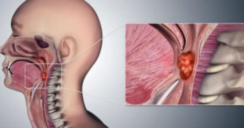 Cảnh báo từ trường hợp ung thư vòm hầu chẩn đoán muộn do chủ quan với hạch cổ