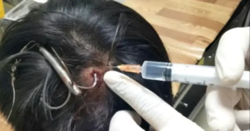 Cảnh báo tai nạn hy hữu: Móc câu găm sâu vào đầu thiếu niên 15 tuổi ở Quảng Trị