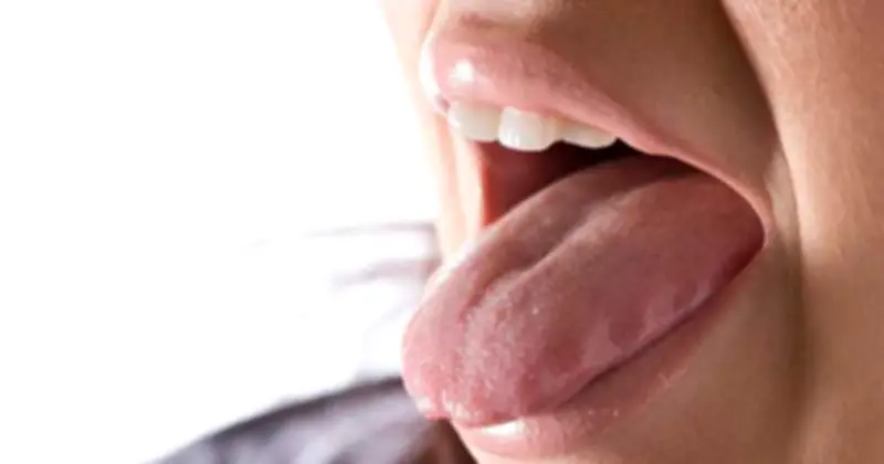 Cảnh báo ung thư lưỡi từ nốt nhiệt miệng: Câu chuyện sống còn của người đàn ông 41 tuổi