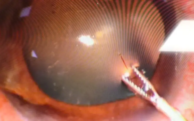 Cấp cứu bệnh nhân 37 tuổi bị ong ruồi chích xuyên giác mạc