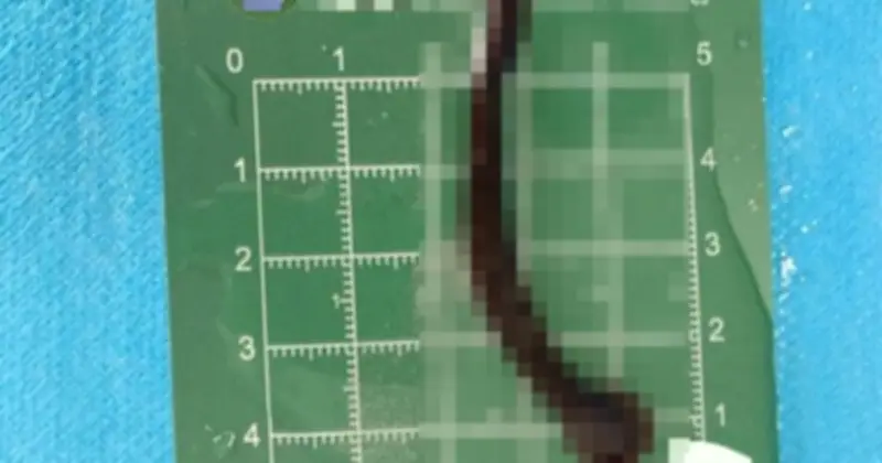 Cậu bé 8 tuổi ho ra máu, bác sĩ kinh ngạc khi lấy con đỉa 8cm từ khí quản