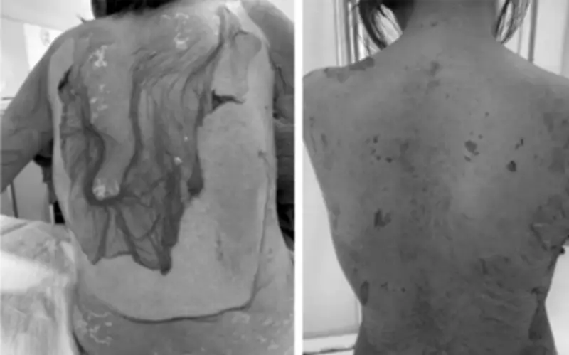 Cứu sống bệnh nhân mắc hội chứng Lyell nguy hiểm do dị ứng thuốc