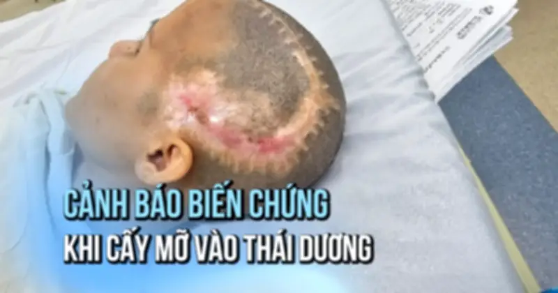 Cấy mỡ tự thân gây đột quỵ hiếm gặp, bệnh nhân trẻ phải mở sọ khẩn cấp