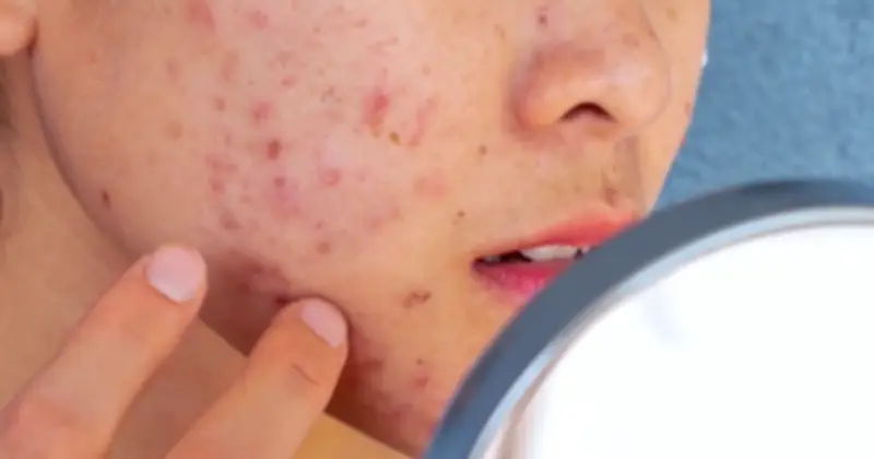 Giải Pháp Chăm Sóc Da Dầu Mụn Mùa Nắng Nóng: Chuyên Gia Chỉ Điểm Sai Lầm