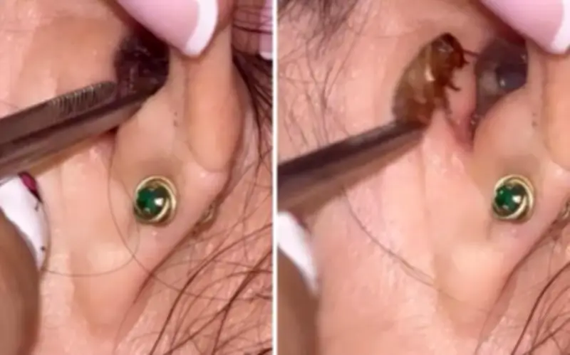 Gián Sống Trong Tai Bệnh Nhân: Clip Kinh Hoàng Lan Truyền Trên TikTok