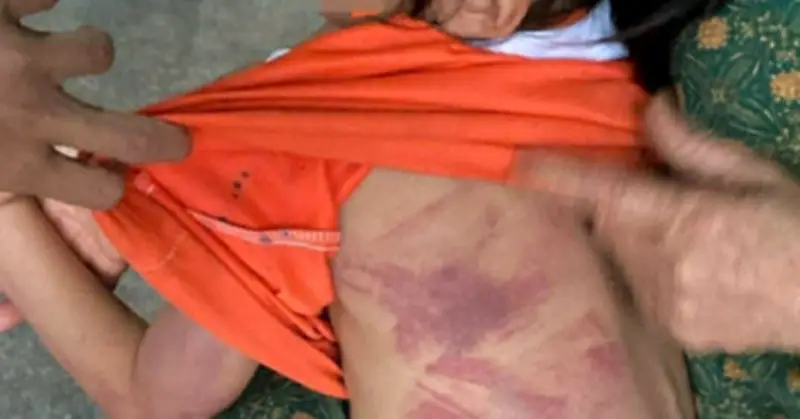 Học sinh lớp 2 bị bạn dùng thước đánh bầm tím người tại trường tiểu học Hà Tông Mục